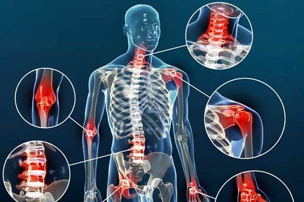  آرتروز، درد خاموش مفاصل بدن
